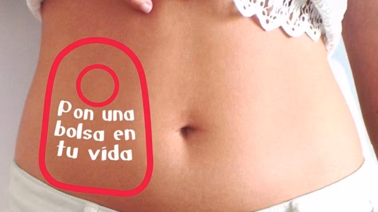 Ostomía